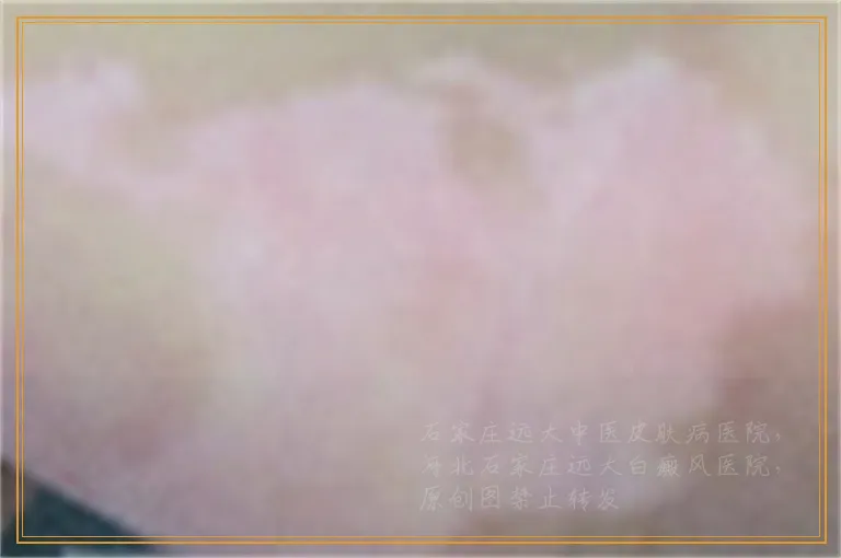照308后白癜风周围发黑中间红是好现象吗