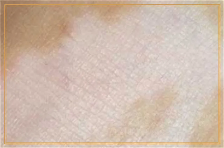白癜风照308后怎么比以前更白是什么原因