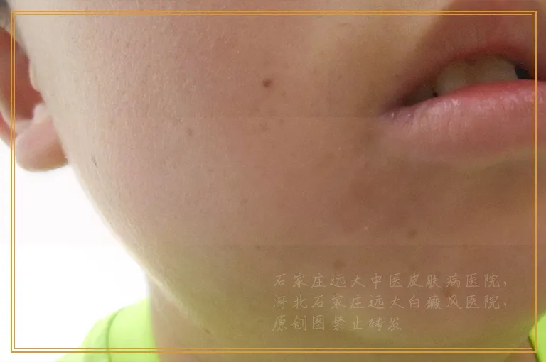 用308激光治疗白癜风后皮肤又红又疼怎么办