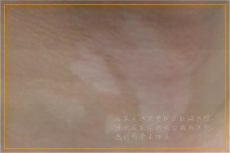 照308后白斑好转的激光迹象有哪些