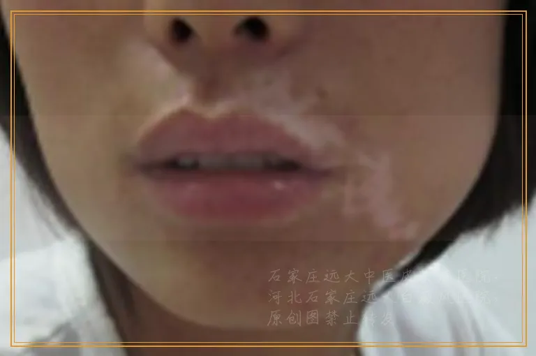 白癜风用308激光治疗大概费用是多少