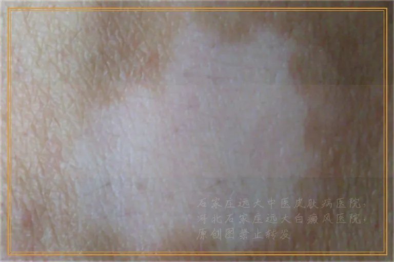 后背白癜风多吃些什么长黑色素