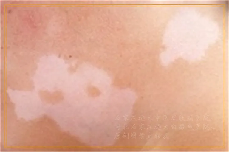 308激光照白癜风是怎么收费的