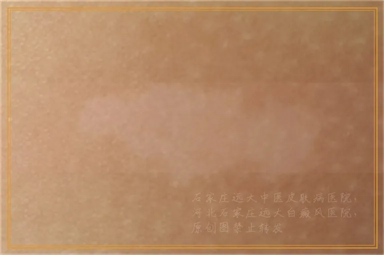 白癜风做黑色素种植后会不会复发