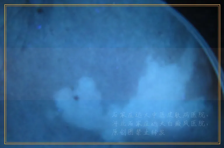 白癜风做黑色素种植费用大概是多少