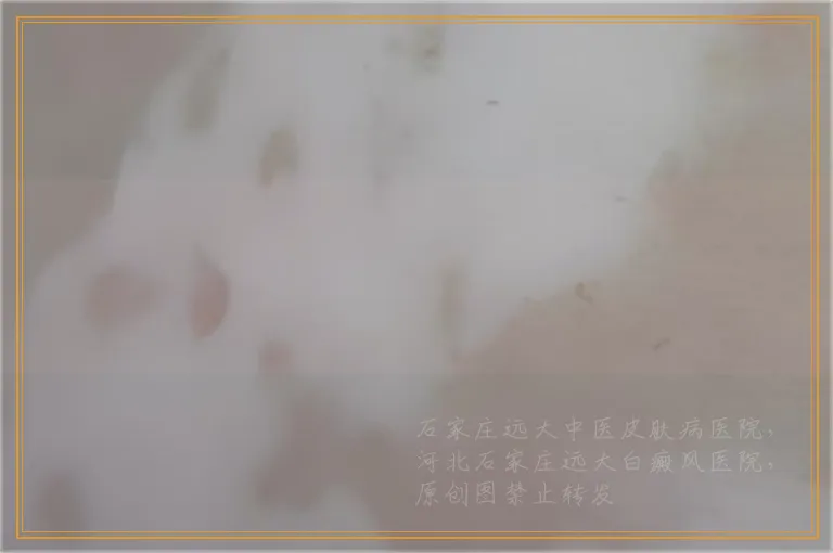 308激光照射白癜风一次多少钱