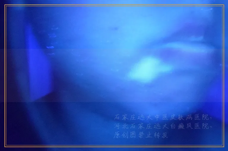 308激光照白癜风具体收费标准是什么