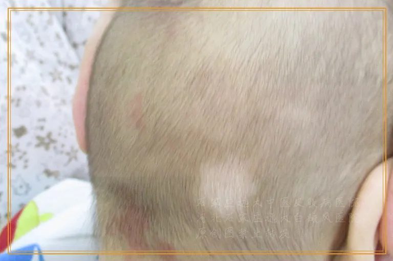 小孩白癜风做黑色素种植用住院吗