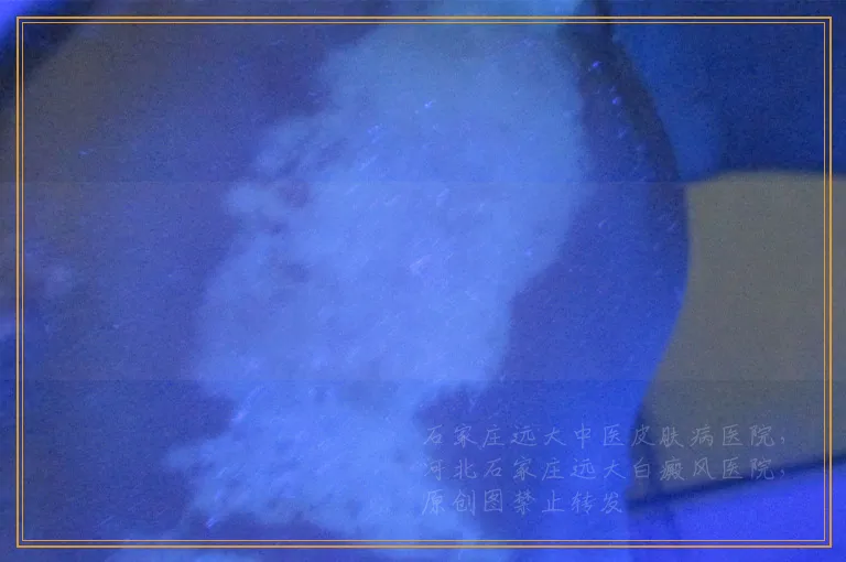 白癜风做三维皮肤ct能查出什么