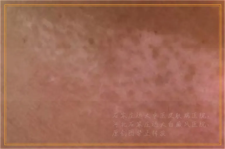 伍德灯照射下白斑有荧光是怎么回事