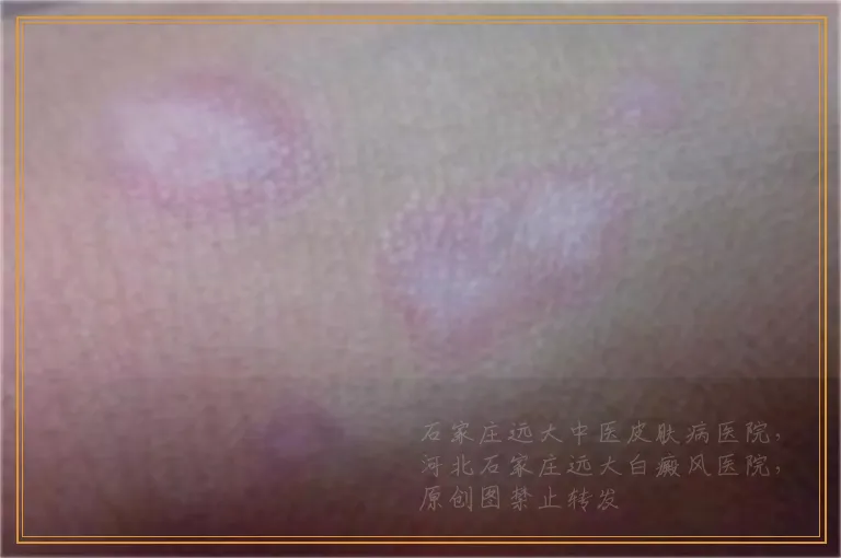 胳膊肘白斑在伍德灯下亮白色是白癜风吗