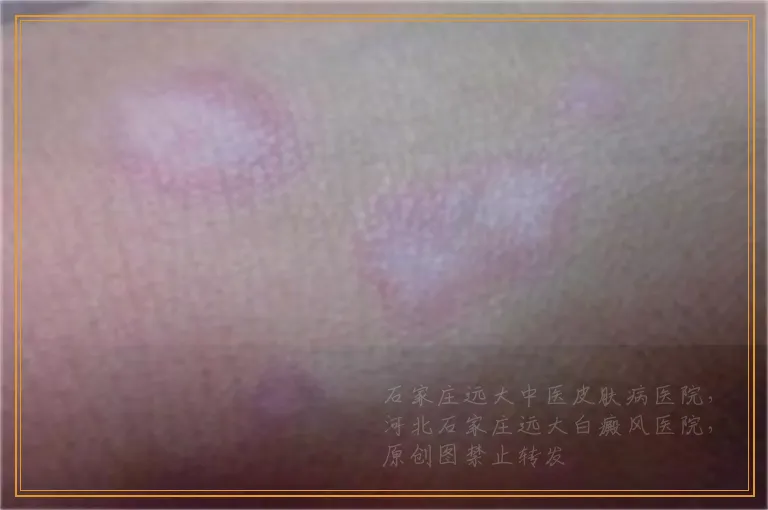 粉白色是不是白癜风做什么检查能确诊