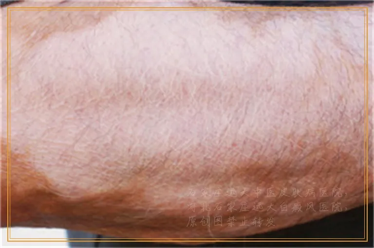 脸上皮肤有白块是不是白癜风