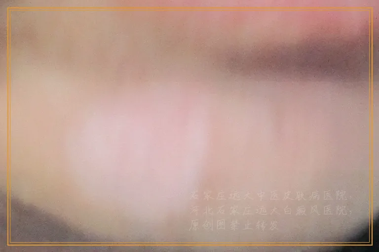 白斑白点不疼不痒是不是白癜风