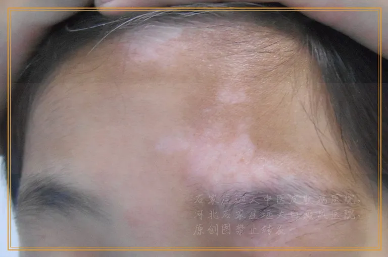 做什么检查能查出白癜风的病因和病情