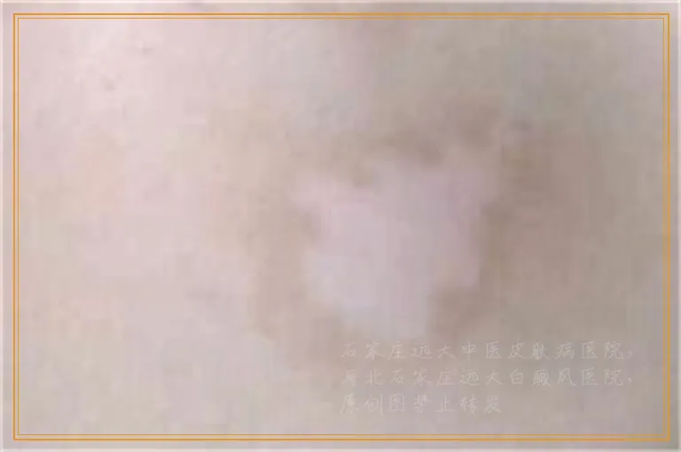 能不能检查胎儿有没有遗传了白癜风