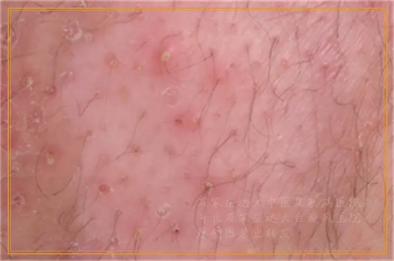 身上刚长的白斑用伍德灯光能确诊吗