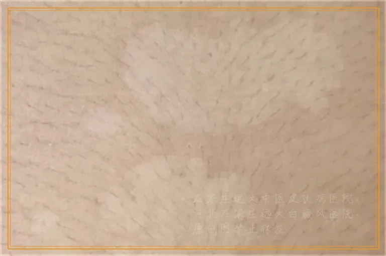 wood灯检查说是白癜风就一定是吗