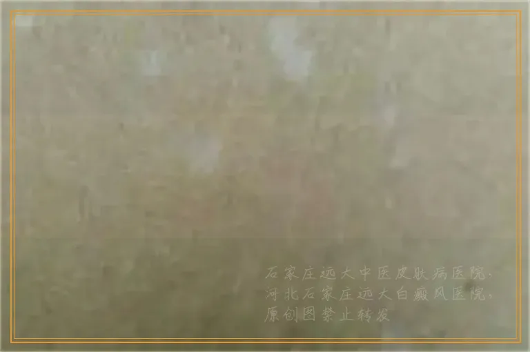 左眼下睫毛那的皮肤变白了是不是白癜风