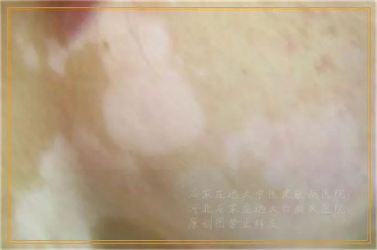 wood灯照白斑说是白癜风准不准