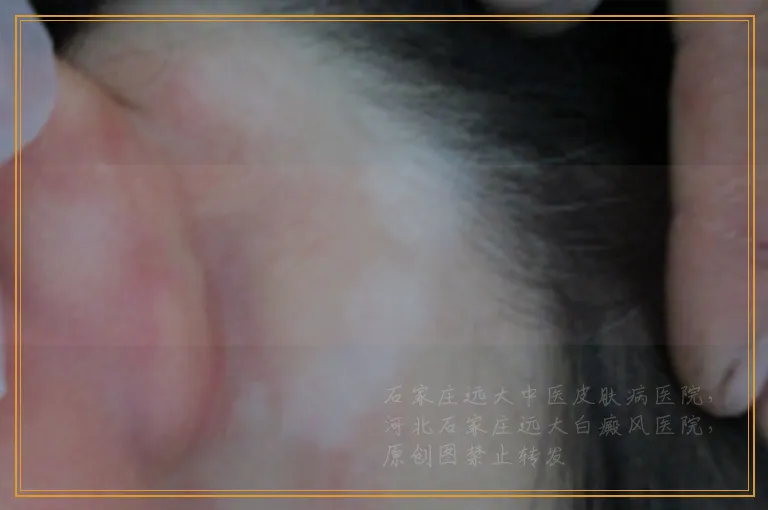 肚子腰上长白斑如何确定是不是白癜风
