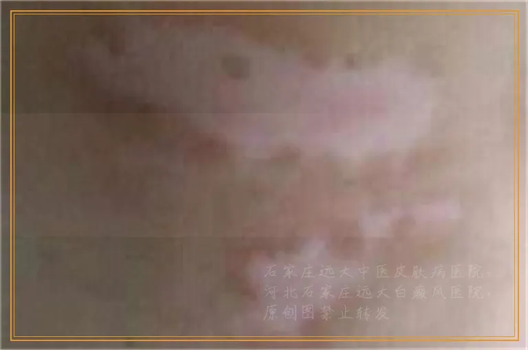 检查是否有白癜风要花多少钱