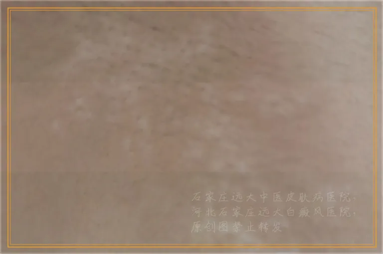 婴儿手臂有一小片白是不是白癜风
