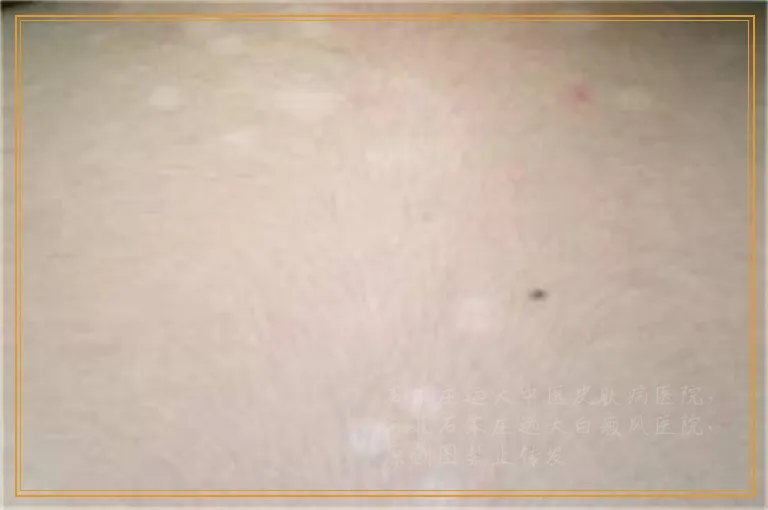 孩子手上有片白色斑要做什么检查