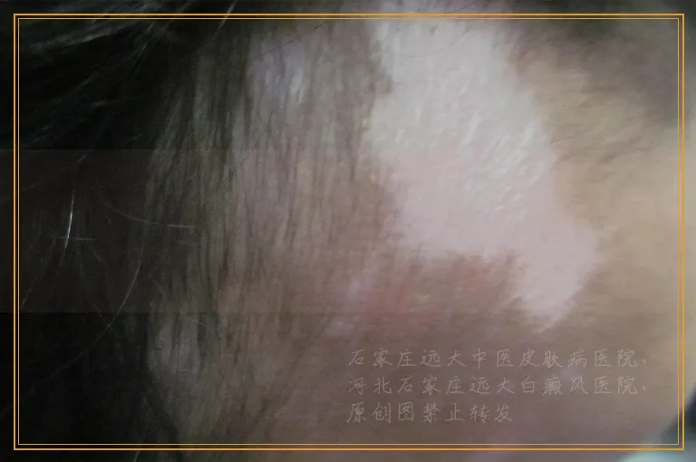 胳膊肘瘙痒变成白斑是不是白癜风