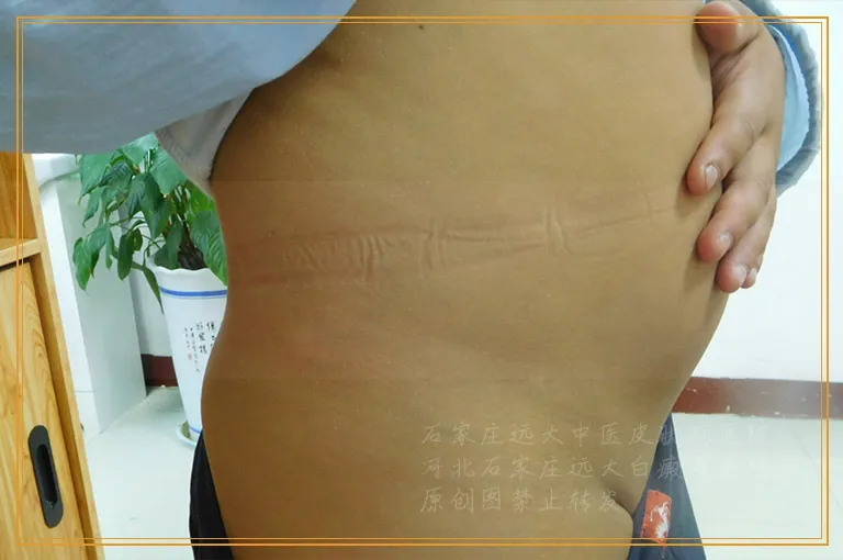 8年的白癜风治疗是不是很贵