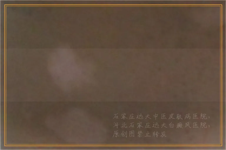 皮肤ct检查白癜风一次需要多少钱