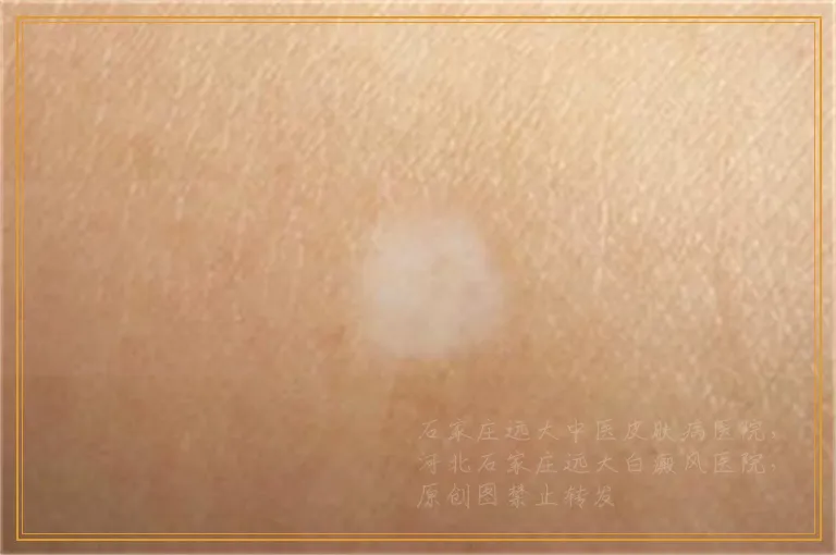 17岁女孩脖子上白斑是不是白癜风