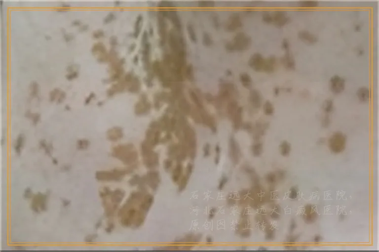 三维皮肤ct检查白癜风的图片