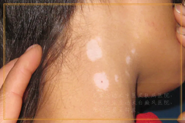 伍德灯检查白斑有怀疑要怎么办