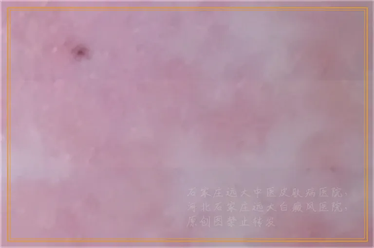 三维皮肤ct真的能查出白斑是不是白癜风吗