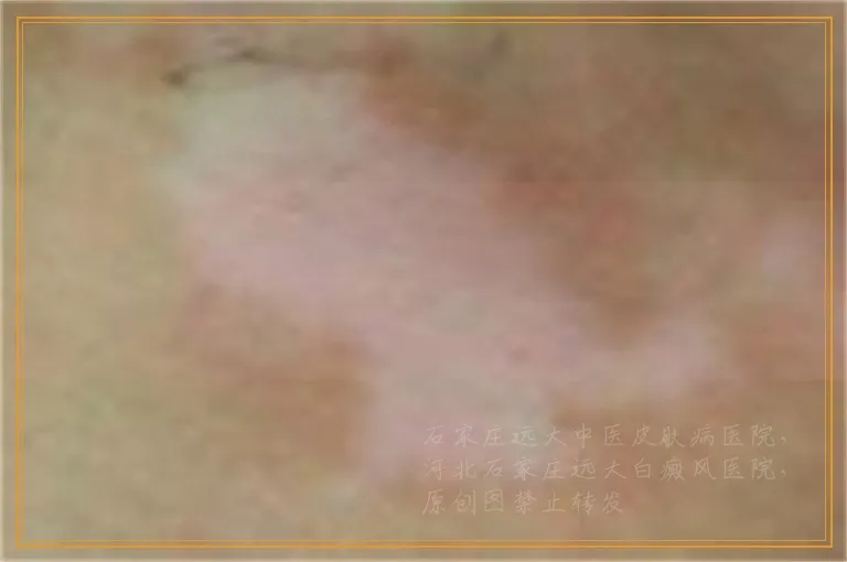 伍德灯下初期白癜风症状图