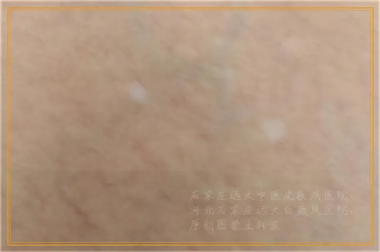 怎么检查身上白色的斑是不是白癜风