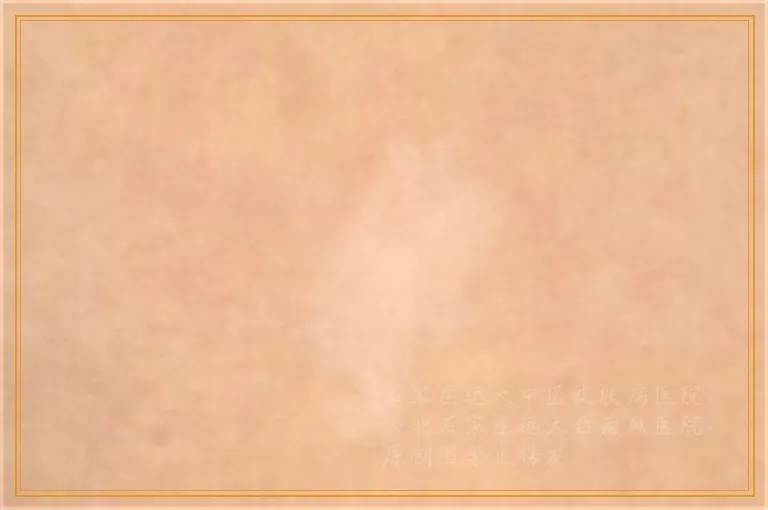 白癜风伍德灯照不出白色是不是就好了