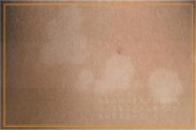 白癜风治疗费用是不是挺高的