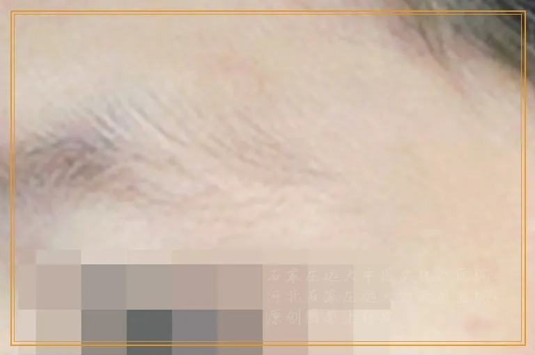 白癜风是不是血液病