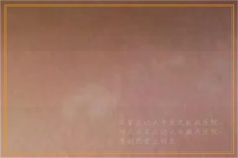 白癜风照UVB周围变黑是不是好转了