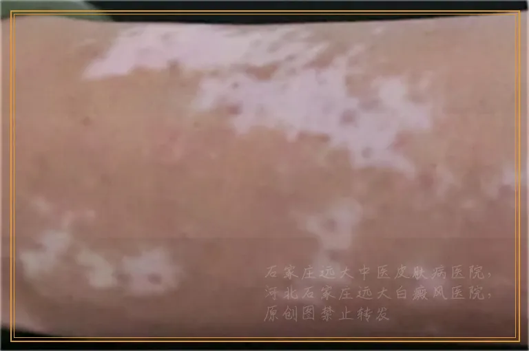 wood灯检测白癜风准确率高不高