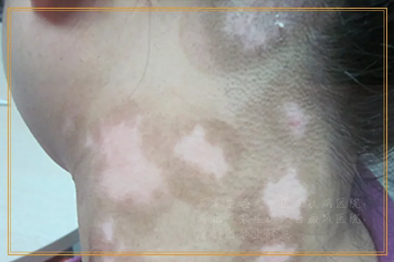 婴幼儿身上长白点怎么判断是不是白癜风