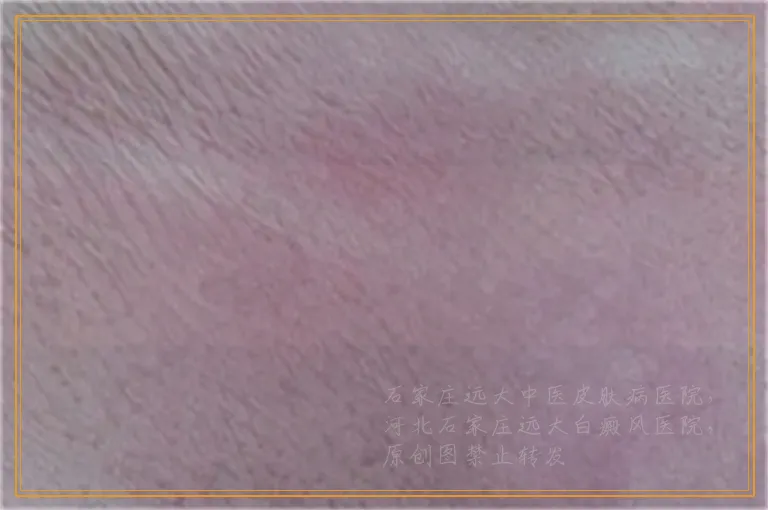 伍德灯检查乳白色边界不清什么意思