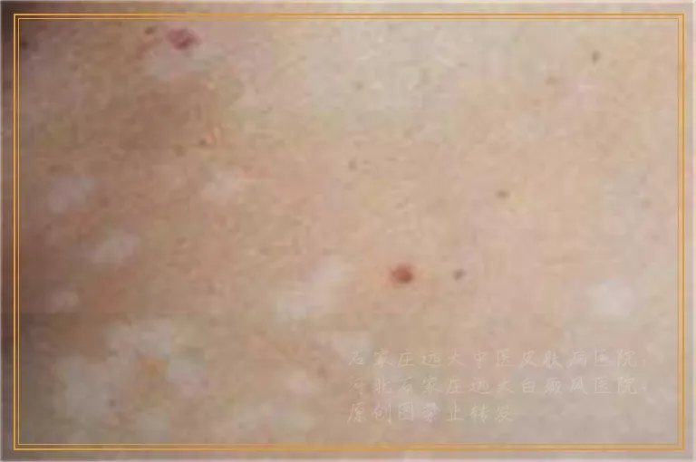 伍德灯照白斑显示蓝白色是不是白癜风