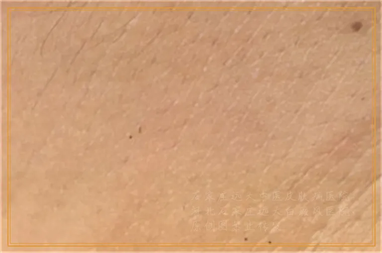 照伍德灯半年没变化可以排除白癜风吗