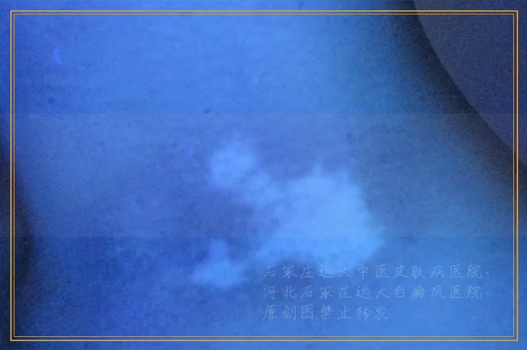 脸上长白点做什么检查能确诊