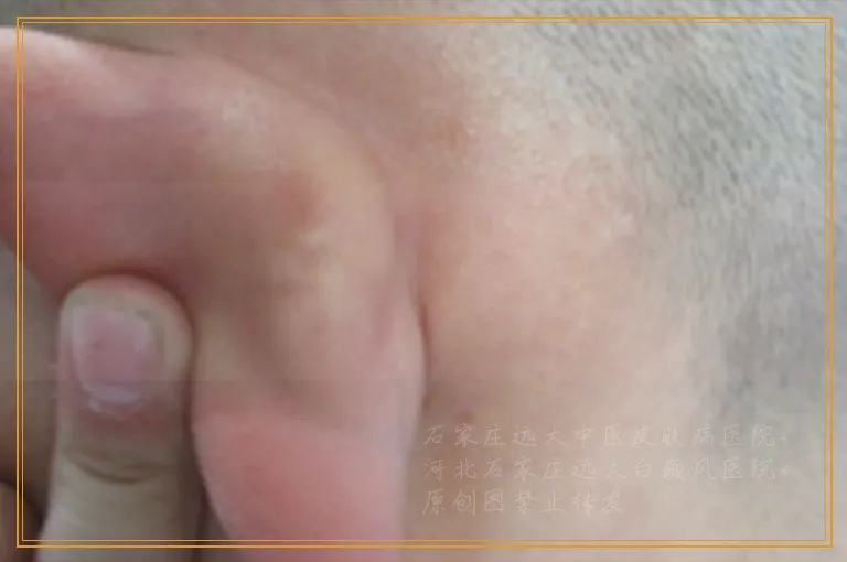 白癜风照伍德灯亮白色严重吗