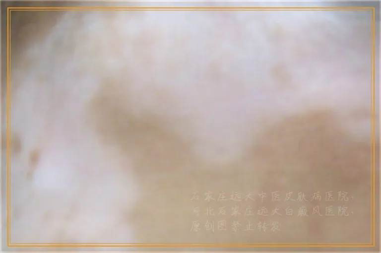 色素减退斑是不是白癜风两者有什么区别