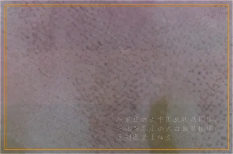 白斑在wood灯下成粉色是什么